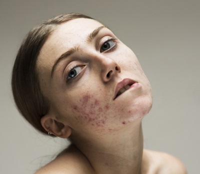 Sophie Harris-Taylor Epidermis